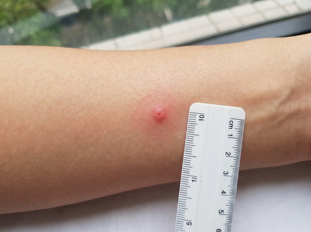 Close-up photograph of a fresh dog tick bite showing a small red bump with the engorged tick still attached to the skin